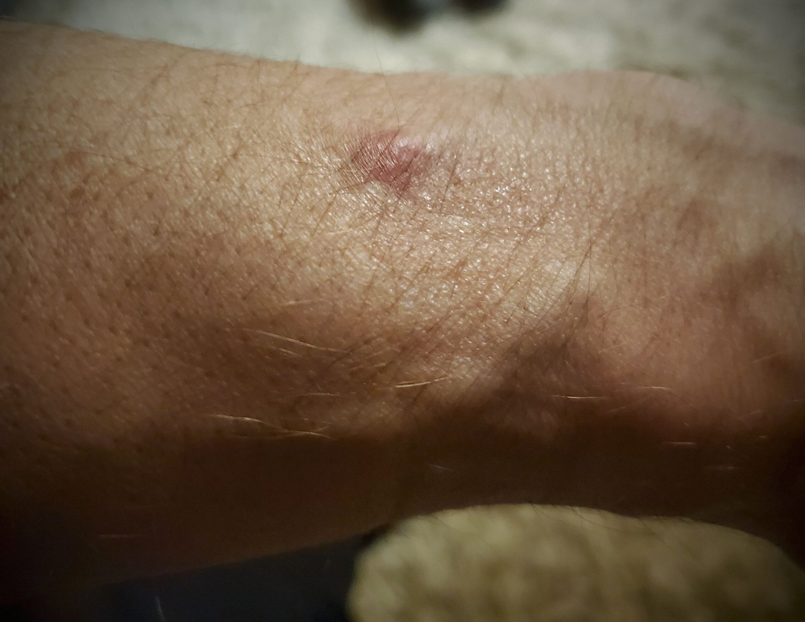 Queimadura causado por smartwatch com sensores de frequência cardíaca em contato com o pulso suado